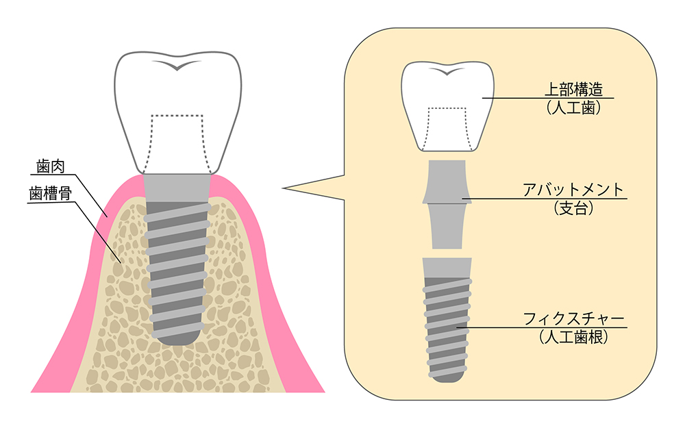 インプラントの構造