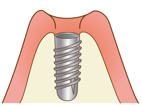 歯茎にインプラントを埋める