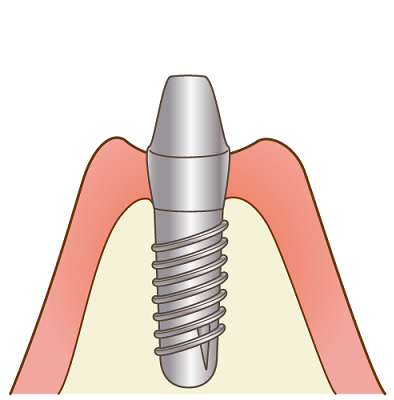 STEP3.インプラント手術（2回目）