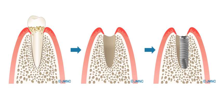 抜歯即時埋入とは